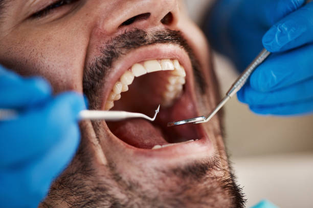 Best Emergency Treatment for Dental Infections or Abscesses in Ke Arthur, LA